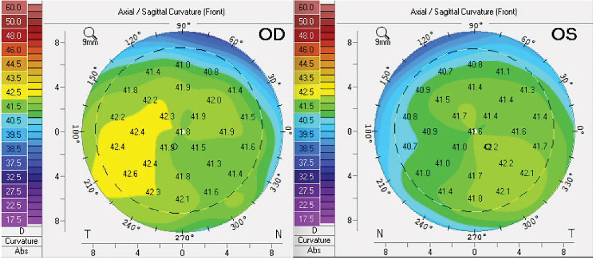 Corneal tomography without evidence of corneal flattening in an individual following four infusions of Elahere.