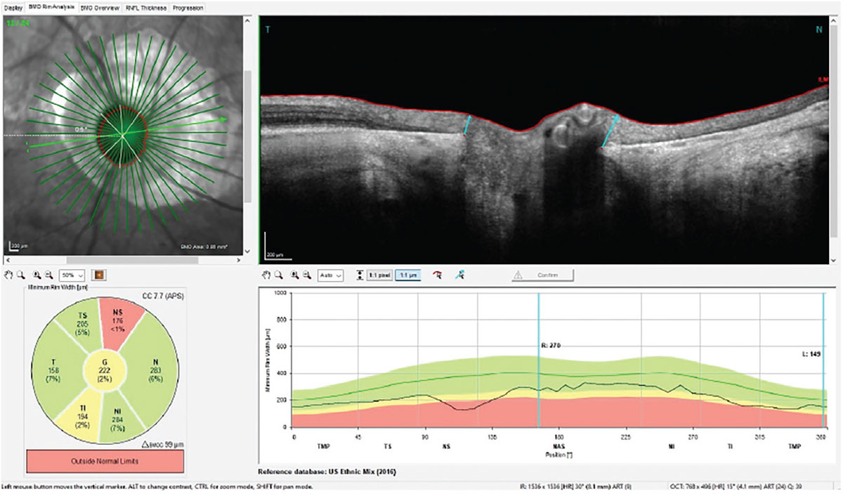 Fig. 3. The radial scans through the neuroretinal rim of the right eye measuring the BMO-MRW, which is completely unaffected by the PPA.