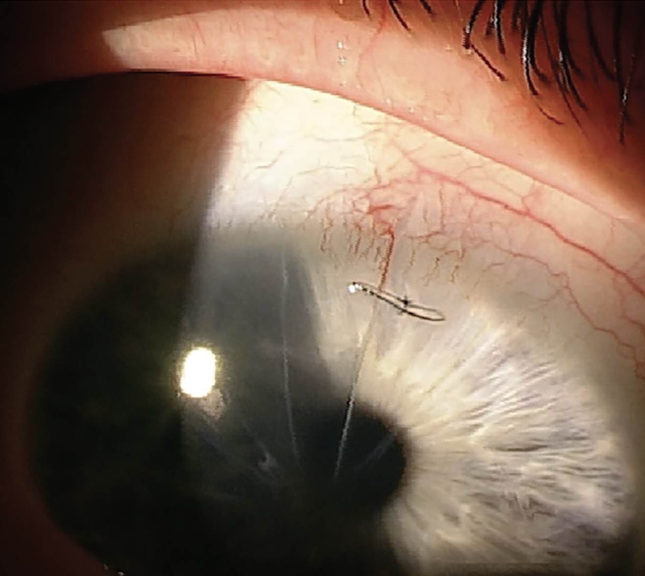 Cataract surgery patient with sutured RK cut.