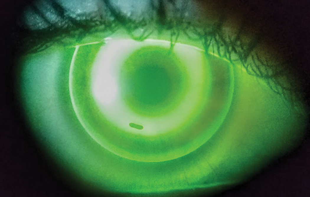 After ortho-K treatment, eyes in the 5mm optic zone group had a smaller treatment zone, although there was no difference in decentration.