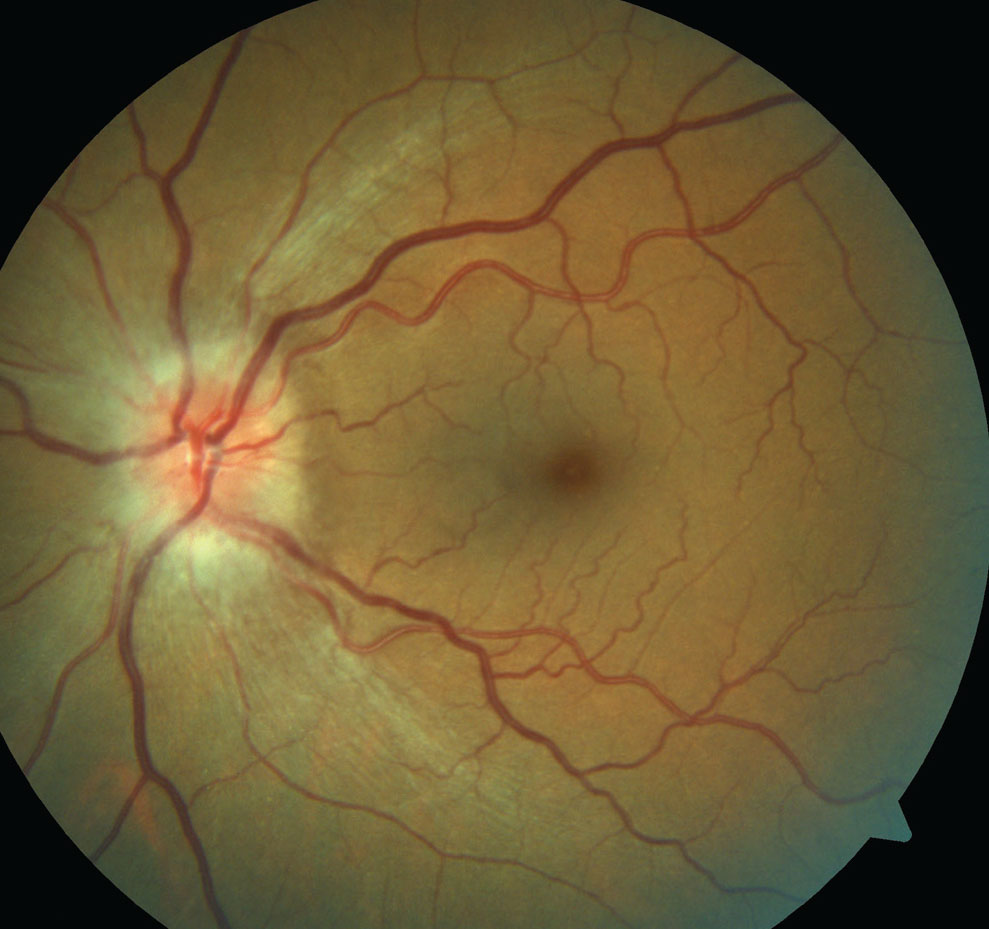 Nasal- and temporal-quadrants were best-suited to predict favorable VF and VA outcomes, respectively. 