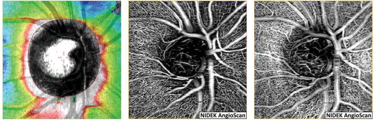 Early OCT-A progression rate was found to be a slightly better predictor of future VF loss than early change rates in OCT RNFL or ganglion cell complex thickness. 