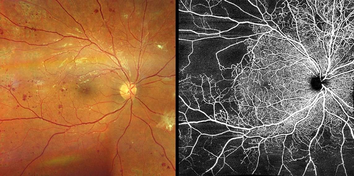 Using certain OCT-A metrics, researchers detected significant capillary nonperfusion in the inner ring area of the superficial capillary plexus for patients in the earliest stage of NPDR but found capillary closure in the superior and deep capillary plexus for patients in both the mild NPDR and moderate or moderately severe NPDR categories.