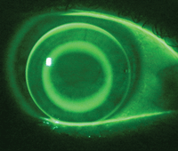 Using computer-aided design and manufacturing techniques to fit ortho-K lenses could reduce the reliance on highly skilled optometrists, shorten the time required for lens fitting and minimize the need for a large number of trial lenses, researchers suggest.