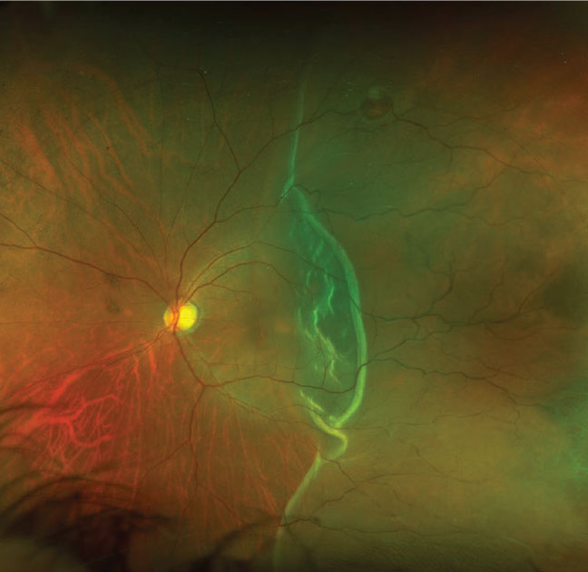 Individuals with conditions leading to elevated risk of retinal detachment, such as cataracts or diabetes, may be more likely to receive oral fluoroquinolones (e.g., for prophylaxis for cataract surgery or to treat diabetes-associated urinary tract infections).