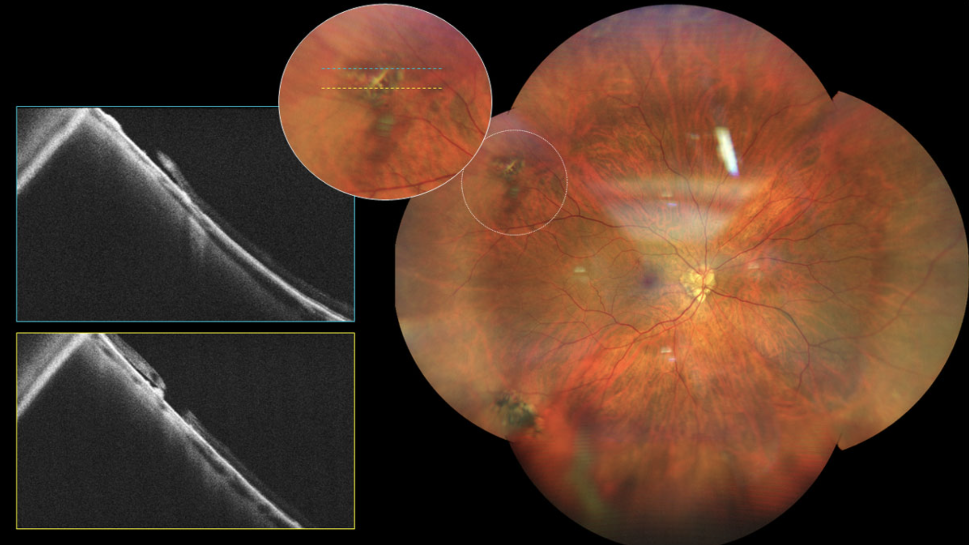 Tailored management strategies are crucial for addressing the distinct challenges presented by degenerative myopia and mitigating its impact on visual health, the authors noted in this study.