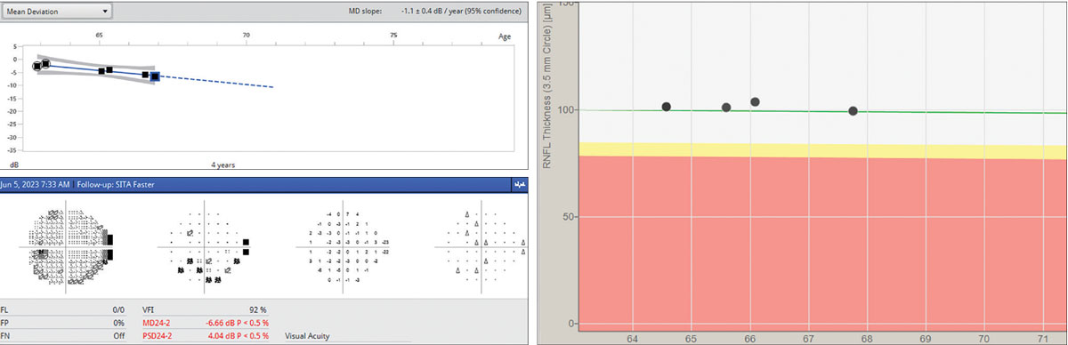 Fig. 1. Demonstrating to patients how their disease is progressing/remaining stable by showing them the actual resources we use to determine treatment success/failure can take some of the mystery out of the process and generate talking points that can help reinforce their knowledge of how their glaucoma is evolving.