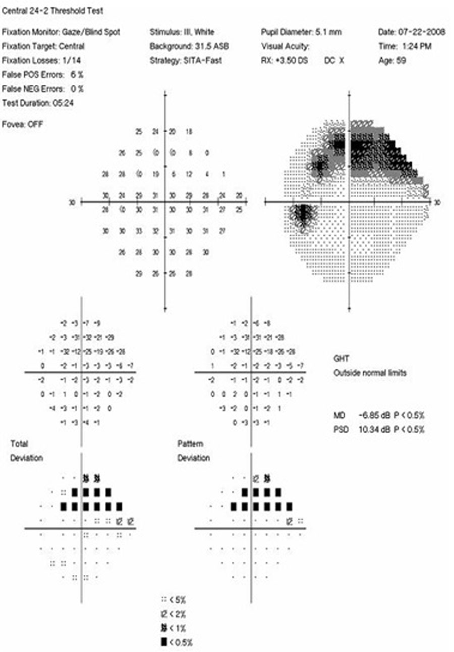 Fig. 4. Visual field associated with glaucomatous optic nerve seen in Figures 2 and 3. This 24-2 Humphrey visual field OS demonstrating a superior temporal arcuate defect correlating to the notch noted on the optic nerve and to the NFL/GCC defects noted on the OCT.