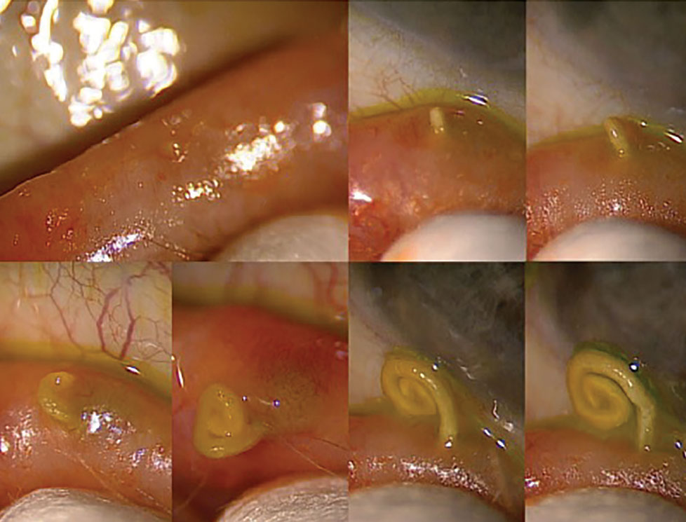 Expression of a gland experiencing obstruction.