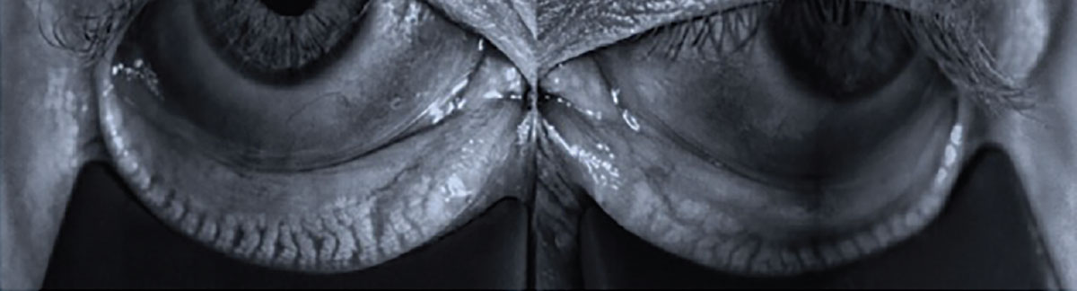 Meibography revealing characteristic signs of meibomian gland dysfunction: gland loss, truncation and tortuosity.