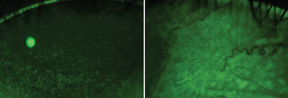 Corneal and conjunctival staining can serve as indicators of a patient's ocular dryness and the specific type of dry eye they may be experiencing.