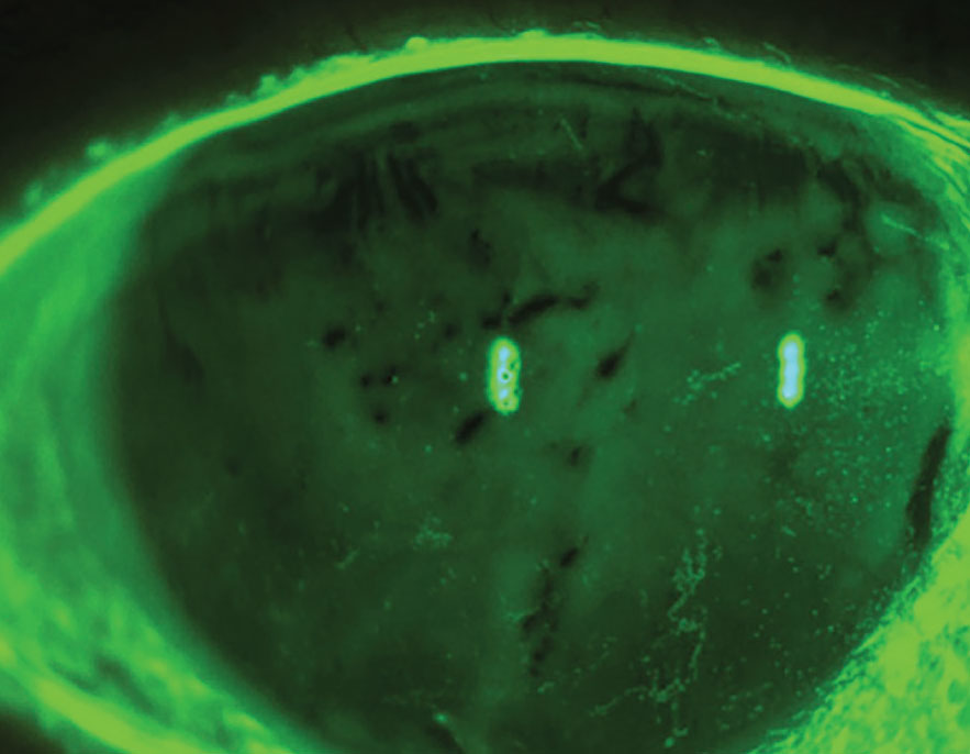 Evaporative dry eye syndrome with reduced tear break-up time and punctate epithelial erosions. Many studies demonstrate O3FAs may help with mitigating signs and/or symptoms. 