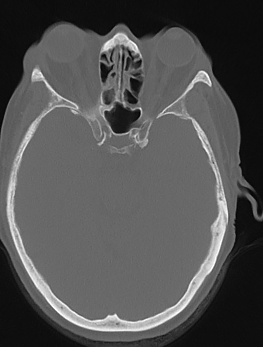 A computed tomography head scan of a patient with known thyroid eye disease, who was symptomatic for dryness and irritation. There is proptosis of both eyes with the right eye displaying more protrusion. The patient’s exophthalmometry reading was 31.5mm OD and 28mm OS.