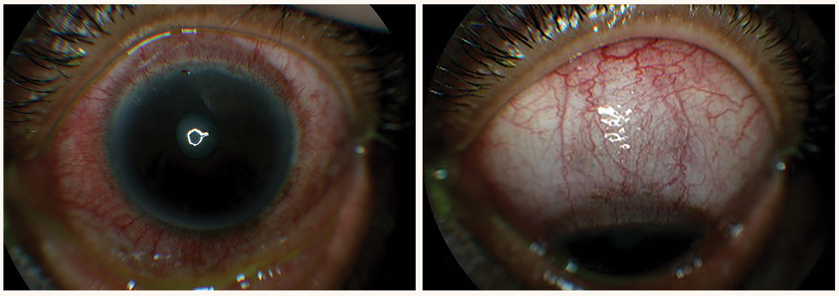 A 65-year-old African American male presented with a red eye OS that started one month ago and reported eye pain, a foreign body sensation and light sensitivity. He was diagnosed with diffuse non-necrotizing anterior scleritis and was treated with oral NSAIDs. He was also referred to rheumatology due to a positive ANA and elevated ANCA testing.