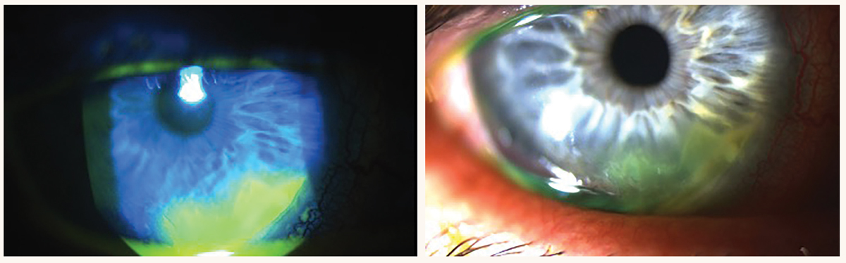 A 49-year-old Caucasian male who presented with a painful red eye. He was diagnosed and treated for PUK, as his symptoms progressed after initially being diagnosed with a corneal abrasion. He had no prior autoimmune conditions but was diagnosed with RF due to elevated RF, CRP, CCP, ANA and ESR.  