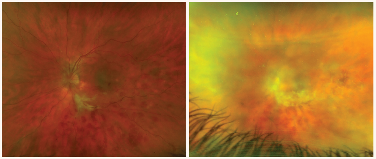 A 40-year-old Caucasian male reported a lightning streak in his left eye that started two days ago with worsening blurred vision, loss of the upper portion of his vision and a red eye. The photo on the left shows vasculitis with disc edema, macular edema, vessel sheathing and hemorrhaging. The photo on the right shows progression of his retinal vasculitis that involved a new complication of panuveitis after four days.