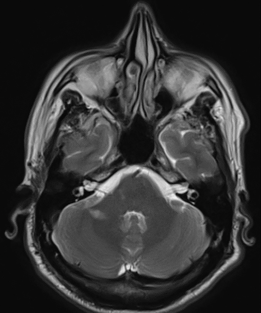 Due to history of known MS and new ganglion cell loss OS, an updated MRI was ordered, which showed progression with new active demyelinating lesions.