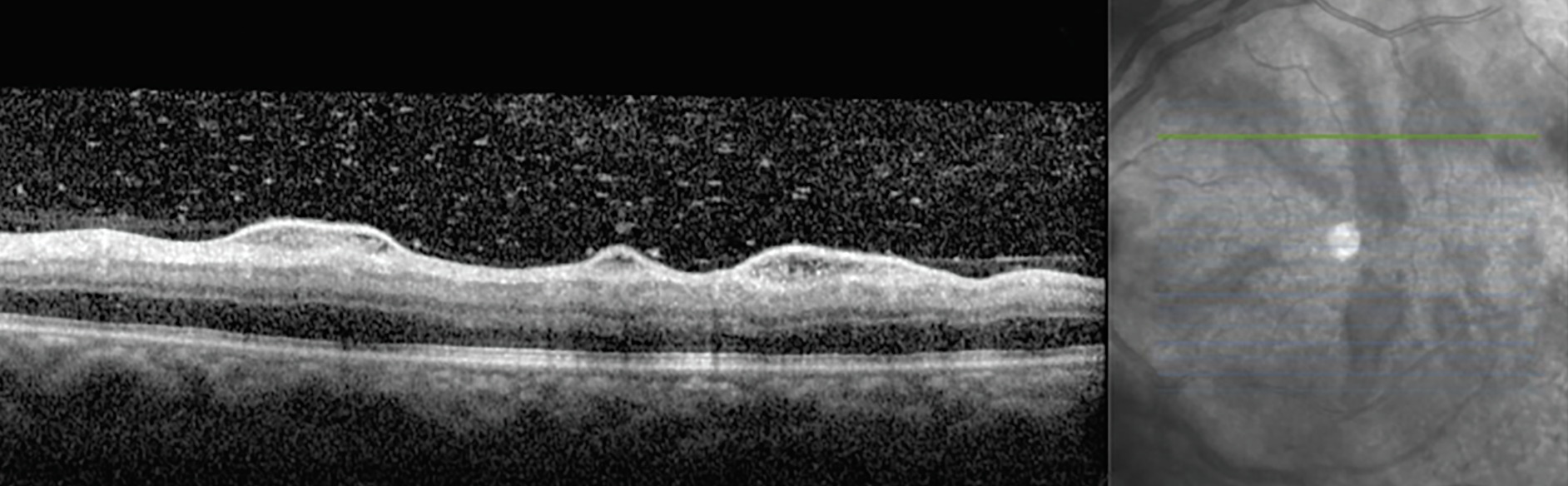 Fig. 2. OCT of the left eye at presentation reveals perivascular serous extravasation and vitreous cell.