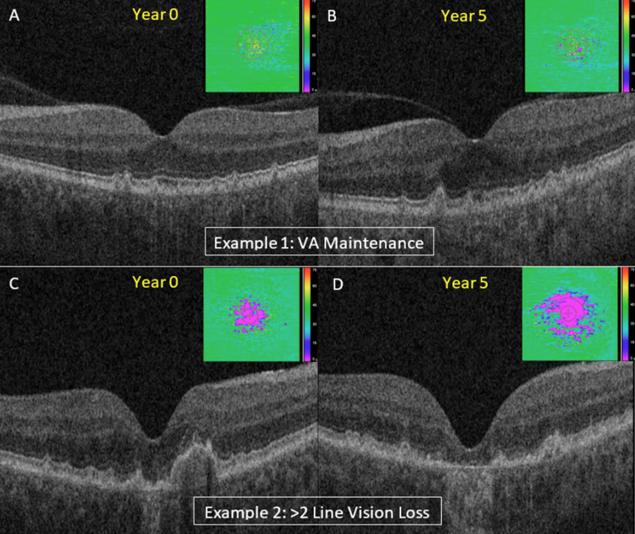 EZ integrity as an imaging biomarker may provide critical support to clinicians to identify dry AMD patients who may be ideal candidates for therapeutic intervention. These images from the study show two subjects with varying EZ attenuation and different progressions of VA changes at year five.