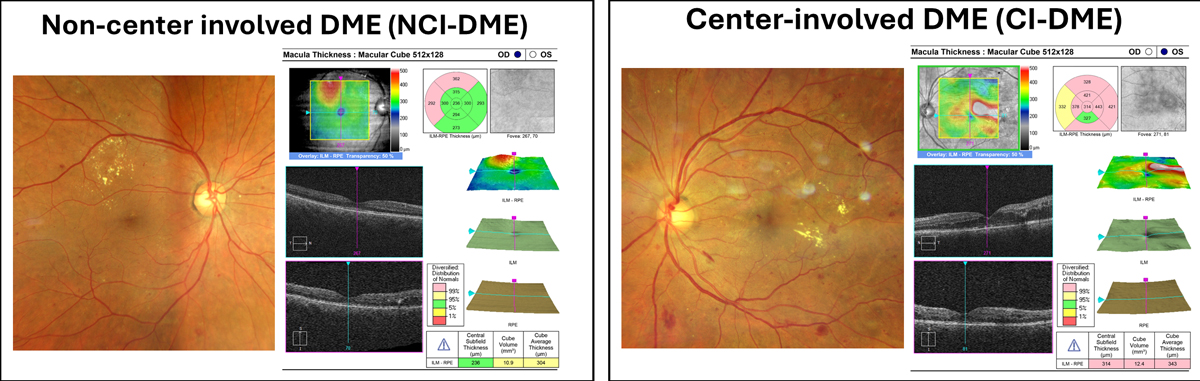 The DME treatment landscape is changing with the advent of novel treatment options.