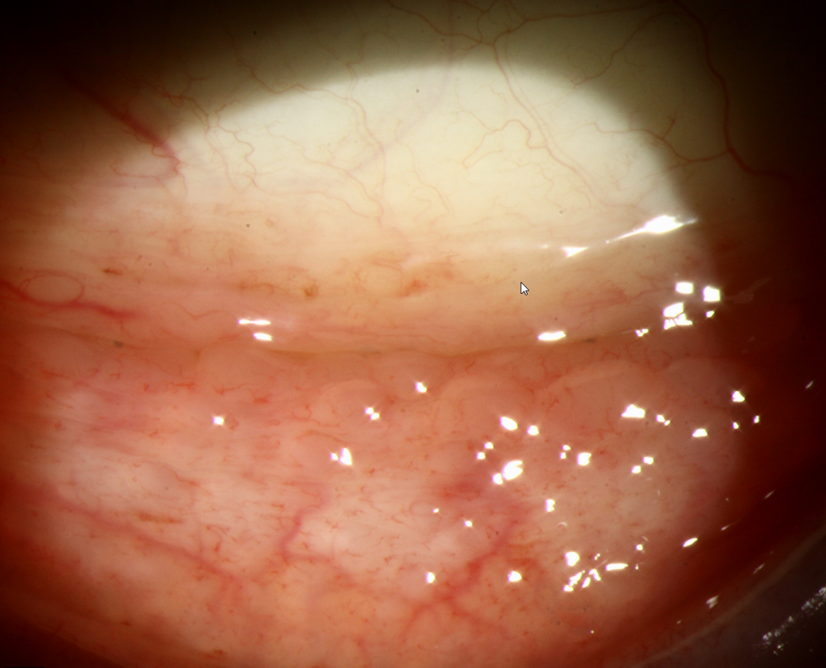 For the first time researchers identified enteroviruses in 0.66% of specimens tested for viral polymerase chain reaction, which manifested mostly as unilateral conjunctivitis and keratitis. Follicular response was common in the cases documented in this study.