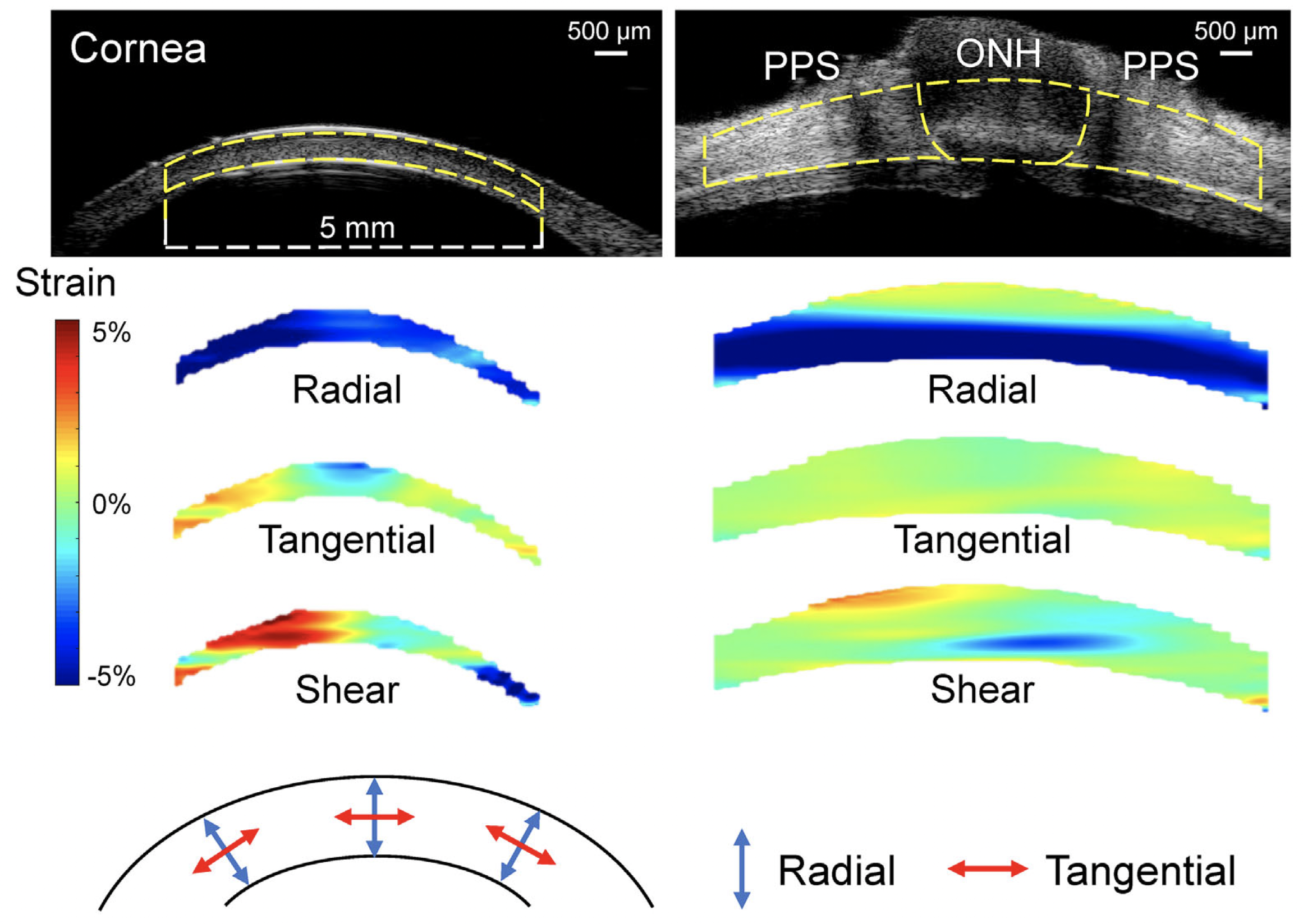 The strong correlation between the cornea’s and the ONH's shear responses to IOP provides new insights and suggests a plausible explanation of the cornea's connection to glaucoma risk. This image from the study shows representative maps of radial, tangential and shear strains in a cornea and a posterior eye of the same donor at 30mm Hg. As the color bar indicates, cyan to blue is negative strain (e.g., compression for radial strain) whereas yellow to red is positive strain (e.g., tensile tangential strain). Dashed yellow lines in the ultrasound images delineate the region of interest for strain analysis.