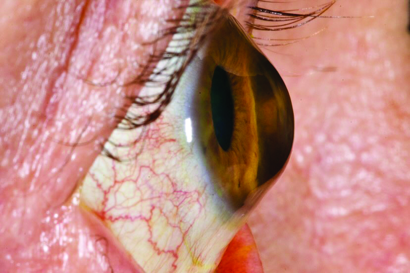 Progression of KC leads to corneal stroma destruction, which in turn causes instability of corneal biomechanical properties and weakened mechanical strength.