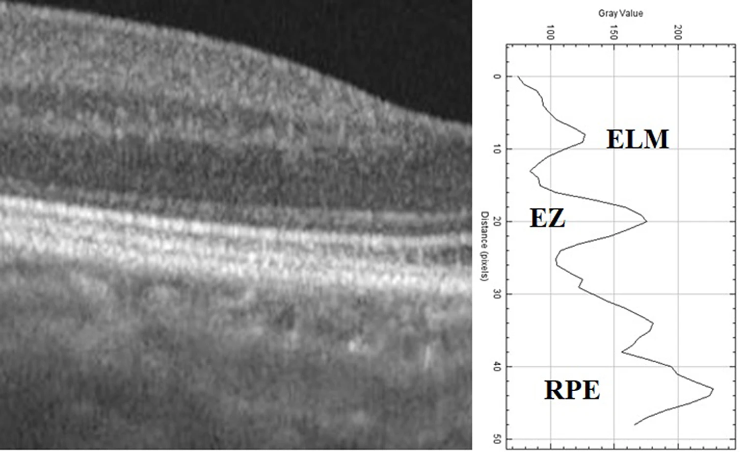 This image from the study shows the peaks of the ellipsoid zone (EZ), external limiting membrane (ELM) and retinal pigment epithelium (RPE) on the reflectivity graph and grayscale OCT.