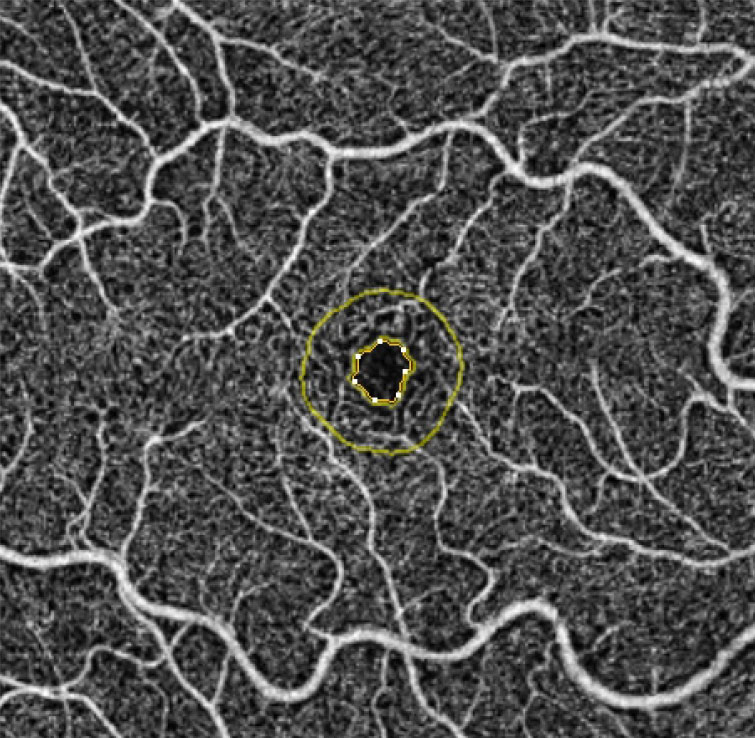 FAZ circularity of the left eye was significantly lower in moderate, severe and PDR compared with no DR, whereas in right eyes these differences were only noticeable in severe and PDR compared with no DR.