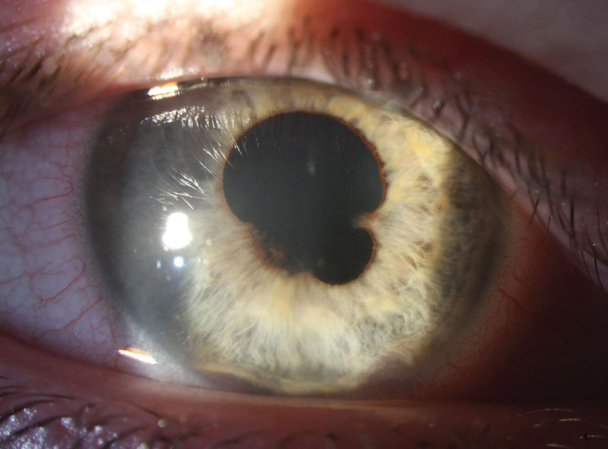 Recurrence in the ipsilateral eye was most prevalent in the viral anterior uveitis group, with relapse in 13.4% by one year, 22.7% by five years and 44.9% by 10 years.