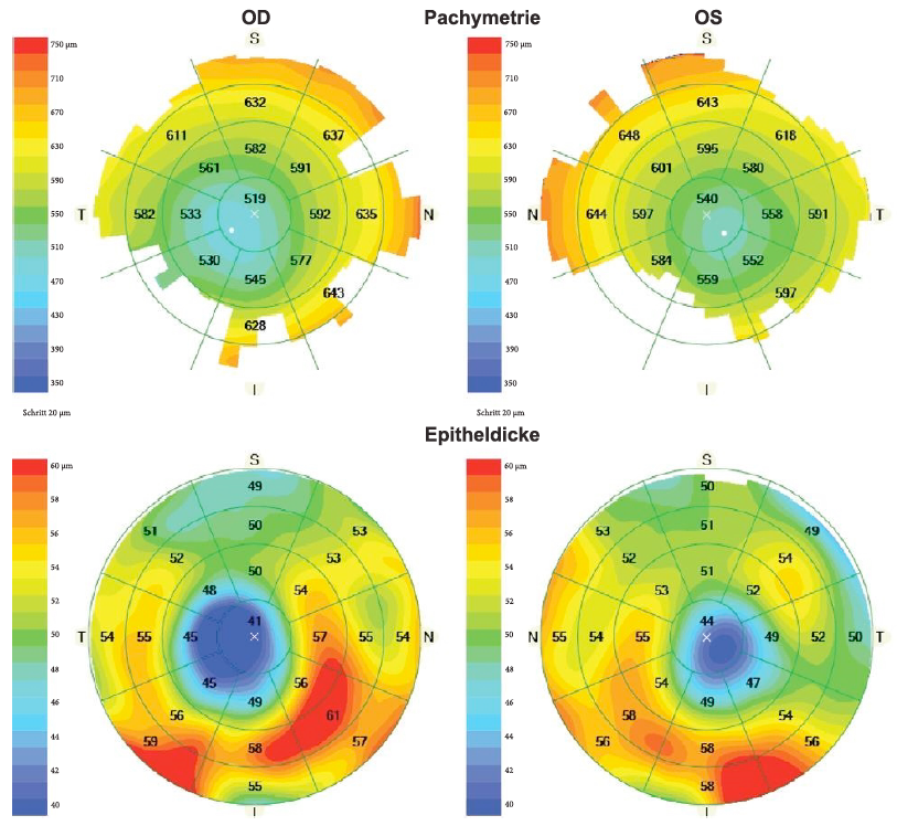 This image from the study shows corneal and epithelial thickness maps of a patient with bilateral manifest keratoconus.