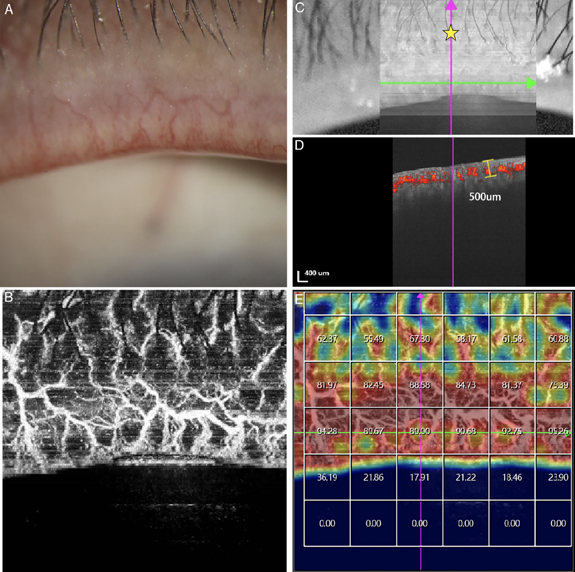 These images from the study show the potential application of swept-source OCT-A measurement of blood flow density in MGD assessment. Fig. (A) shows severe lid margin vascularity by slit-lamp examination. Fig. (B) shows that blood flow by OCT-A was consistent with the blood vessel network. In Fig. (C), the yellow asterisk denotes the site of the analysis center at the palpebral margin below. Fig. (D) provides the measured depth of vascularity (approximately 500μm). Finally, Fig. (E) presents a vascular density map with a 1x1mm grid.