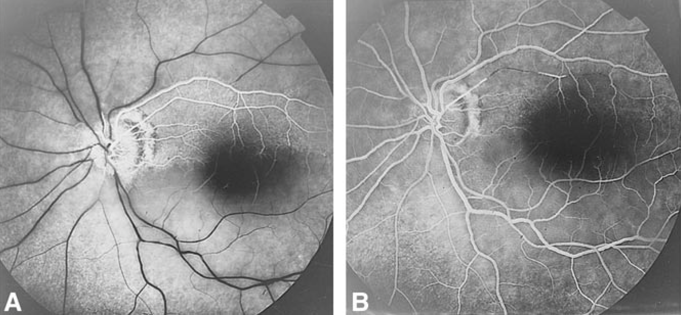 Urgently sending a CRAO patient for intra-arterial thrombolysis, ideally within a few hours of onset, will help patients avoid irreversible retinal damage and vision loss, though the authors of this study believe the intervention may still improve vision to some extent when done within a few days. These fluorescein angiography images (from a different study) show diffuse hypoperfusion of the retinal vessels before treatment (A) and nearly complete recanalization immediately after (B).