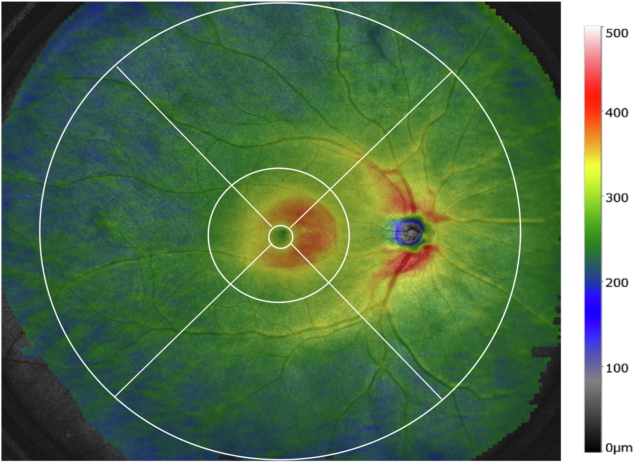 Researchers observed a significant association between age and axial length and macular retinal volume, as well as between laterality and peripheral retinal volume. This color-coded en face retinal thickness map from the study averages the scans of healthy volunteers. The circles are at diameters of 1mm, 6mm and 20mm from the fovea