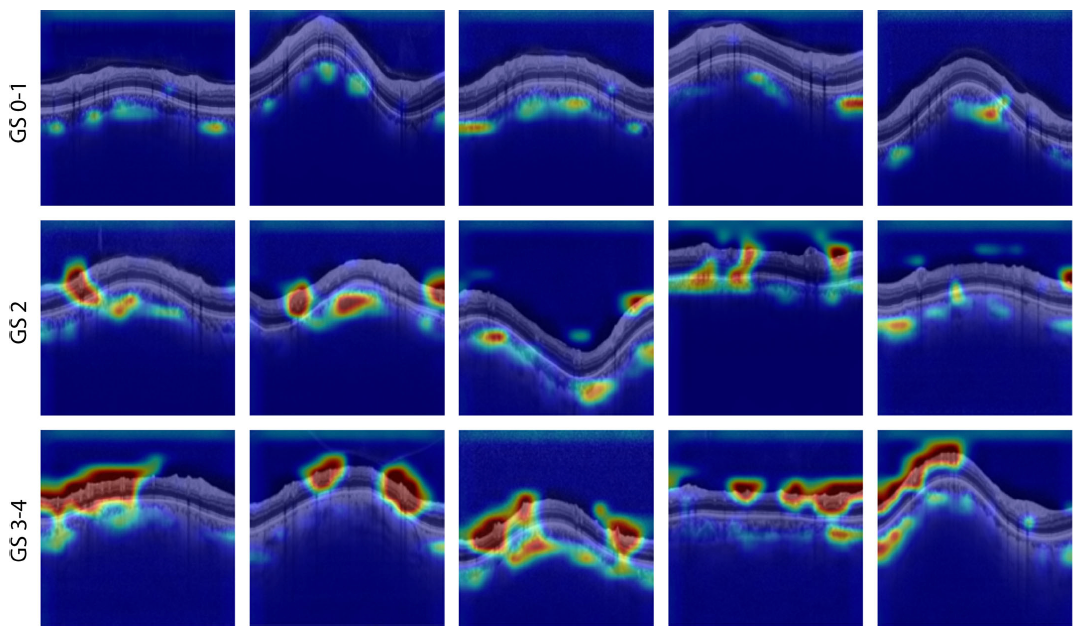 In the future, objective measures recorded with SD-OCT may help improve individualized glaucoma care by adjusting VF testing frequency based on deep-learning estimates of functional damage. In this image from the study, an AI technique called class activation mapping is used to highlight areas of peripapillary OCT scans that contribute to the patient’s visual performance as determined by standard automated perimetry (SAP). Examples of early (top row), moderate (middle) and advanced glaucoma (bottom) are shown. In time, the researchers believe, AI models will be able to predict VF status without need for the patient’s SAP data.