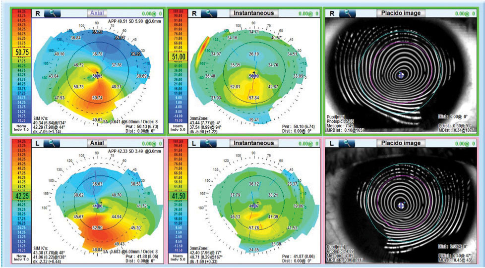 Patients with higher inter-eye asymmetry in Kmax may require closer follow-up since they’re more likely to progress; however, age is the most significant progression predictor.