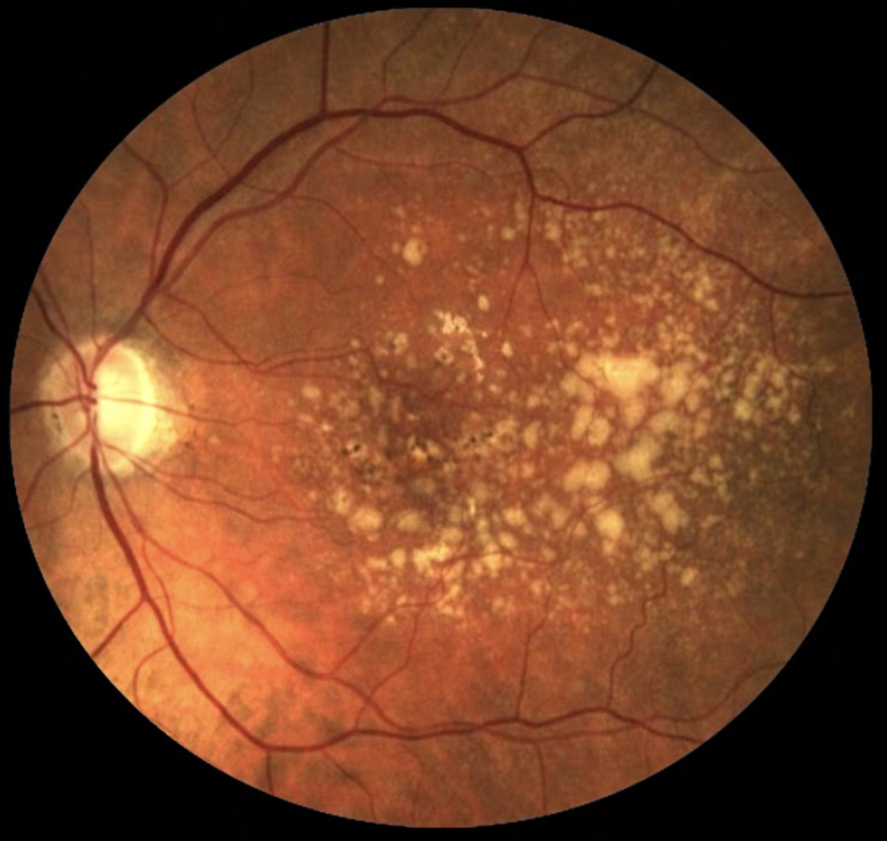 Studies have shown that melatonin opposes key pathological processes that mediate AMD, including dysregulated apoptosis, choroidal neovascularization and oxidative damage. 