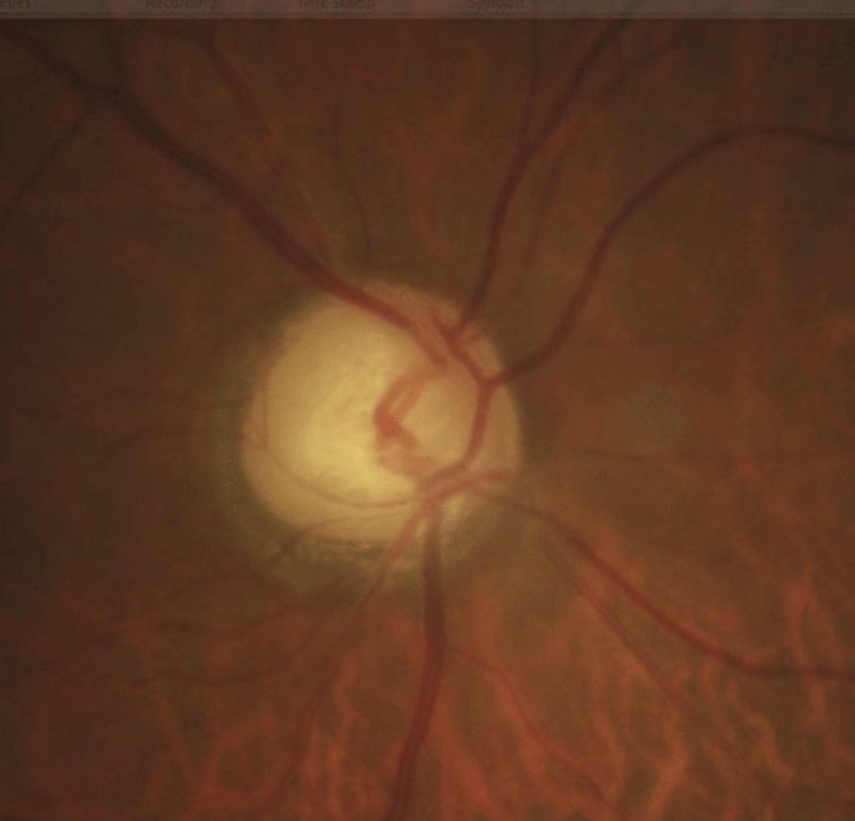 After five years, more than five times as many eyes with higher baseline IOP had progressed in the mono-treated group than in the multi-treated group.