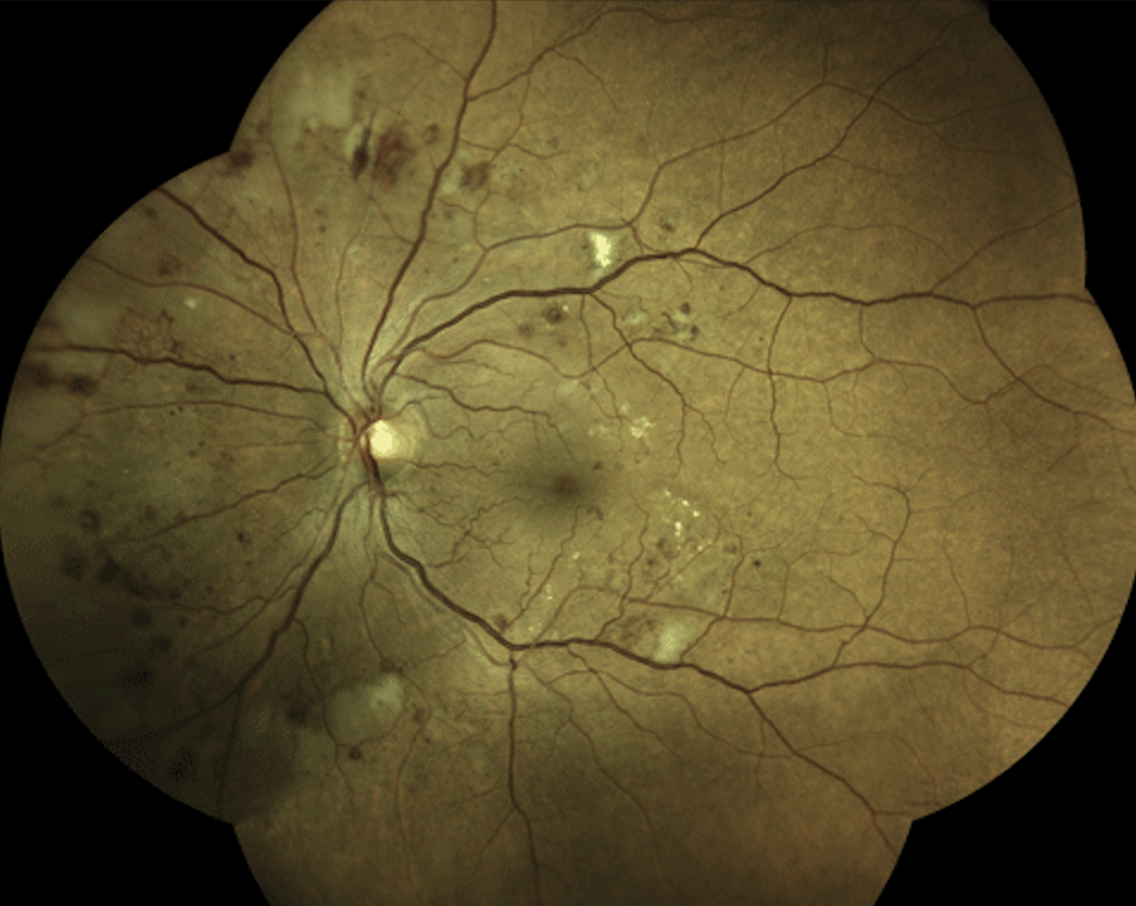 A new study emphasizes the importance of controlling hypertension early in diabetes, even before the onset of diabetic retinopathy. 