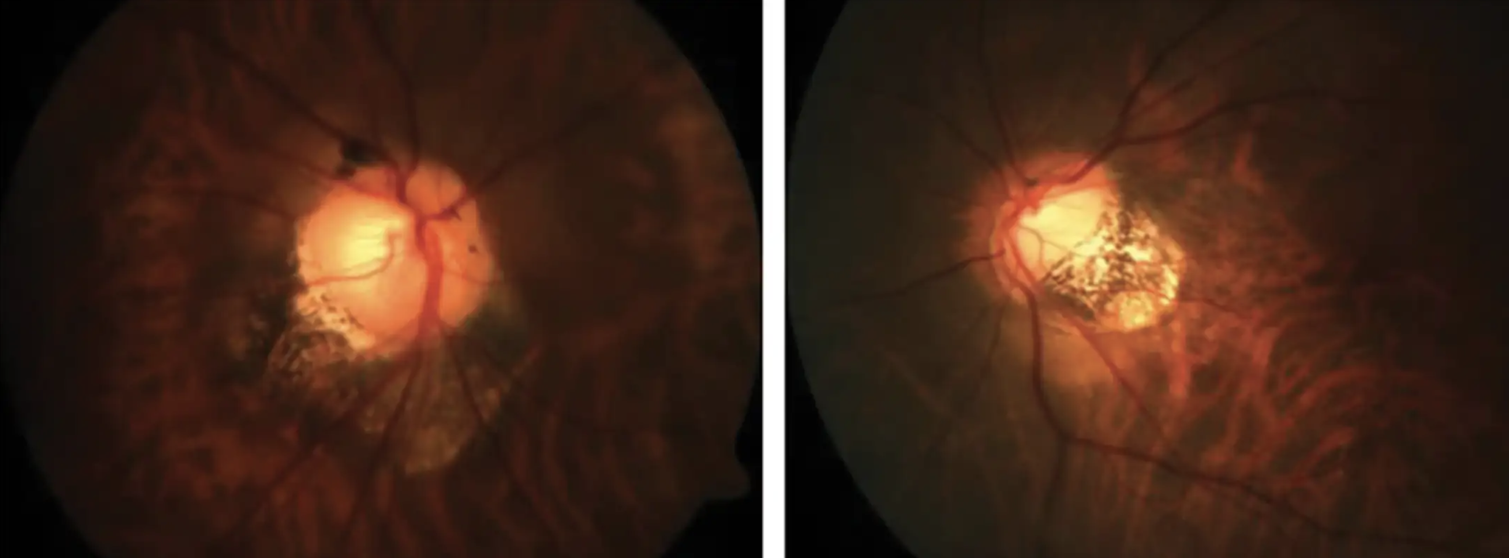 Eyes with compound wide macular posterior staphyloma had higher grades of myopic macular degeneration and higher frequency of neovascularization and foveal change associated with myopic macular traction. 