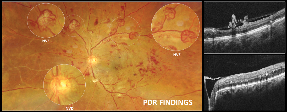 Neovascularization in PDR is preretinal and located on top of the retina. It can be classified as neovascularization of the disc (NVD, on or within one disc diameter from the disc margin) or neovascularization of the retina elsewhere (NVE).