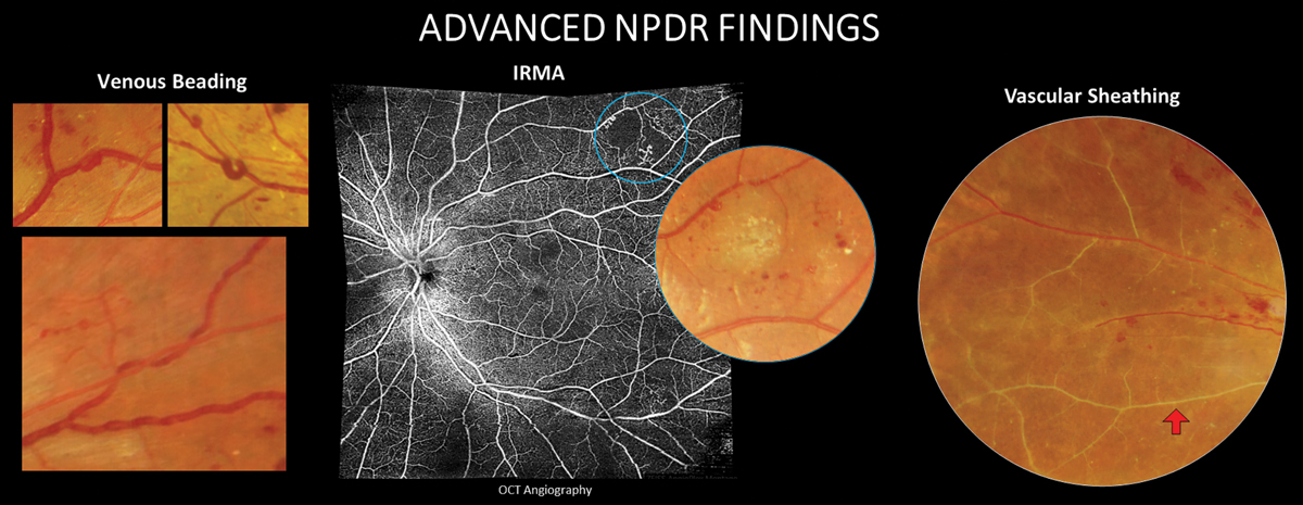 More severe NPDR findings that increase the risk for future conversion to PDR.