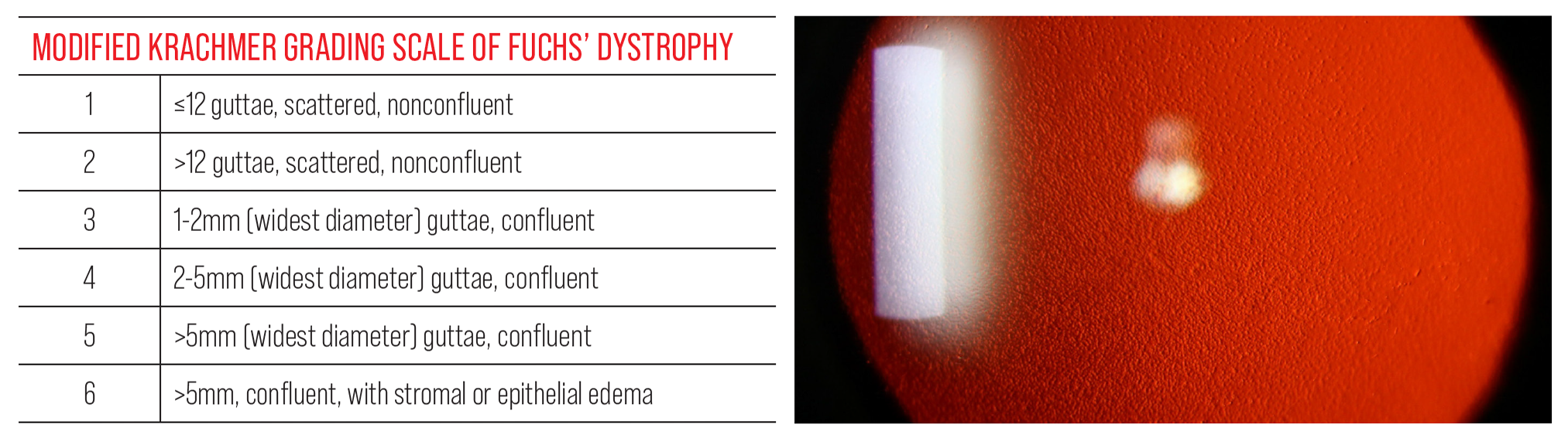 Be mindful that FECD patients graded level 3 or higher are likely to experience forward and anterior backward light scatter affecting visual performance.