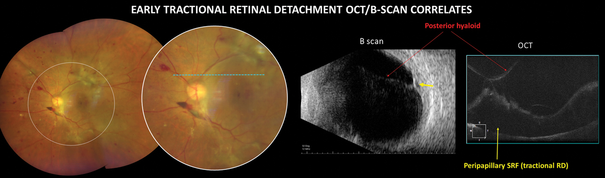 TRD in PDR is an advanced complication that can cause severe, irreversible vision loss.