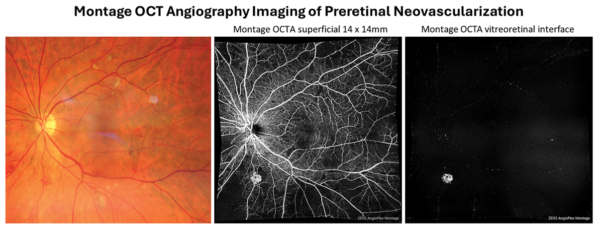 Preretinal neovascularizaton can be isolated out using the vitreous or vitreoretinal interface preset en-face display of OCT-A. This allows for the earliest detection of even subclinical PDR.