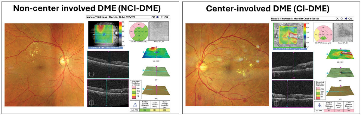 Staging of retinopathy and DME offers an organized approach for management based upon risk of progression and ultimately, risk of vision loss. CI-DME is defined as thickening within the central subfield zone (1mm in diameter).