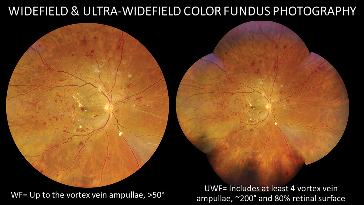 A traditional dilated fundus exam is still the standard of care for diabetes retinal assessment from a legal perspective, but widefield imaging is a highly valuable adjunctive tool.