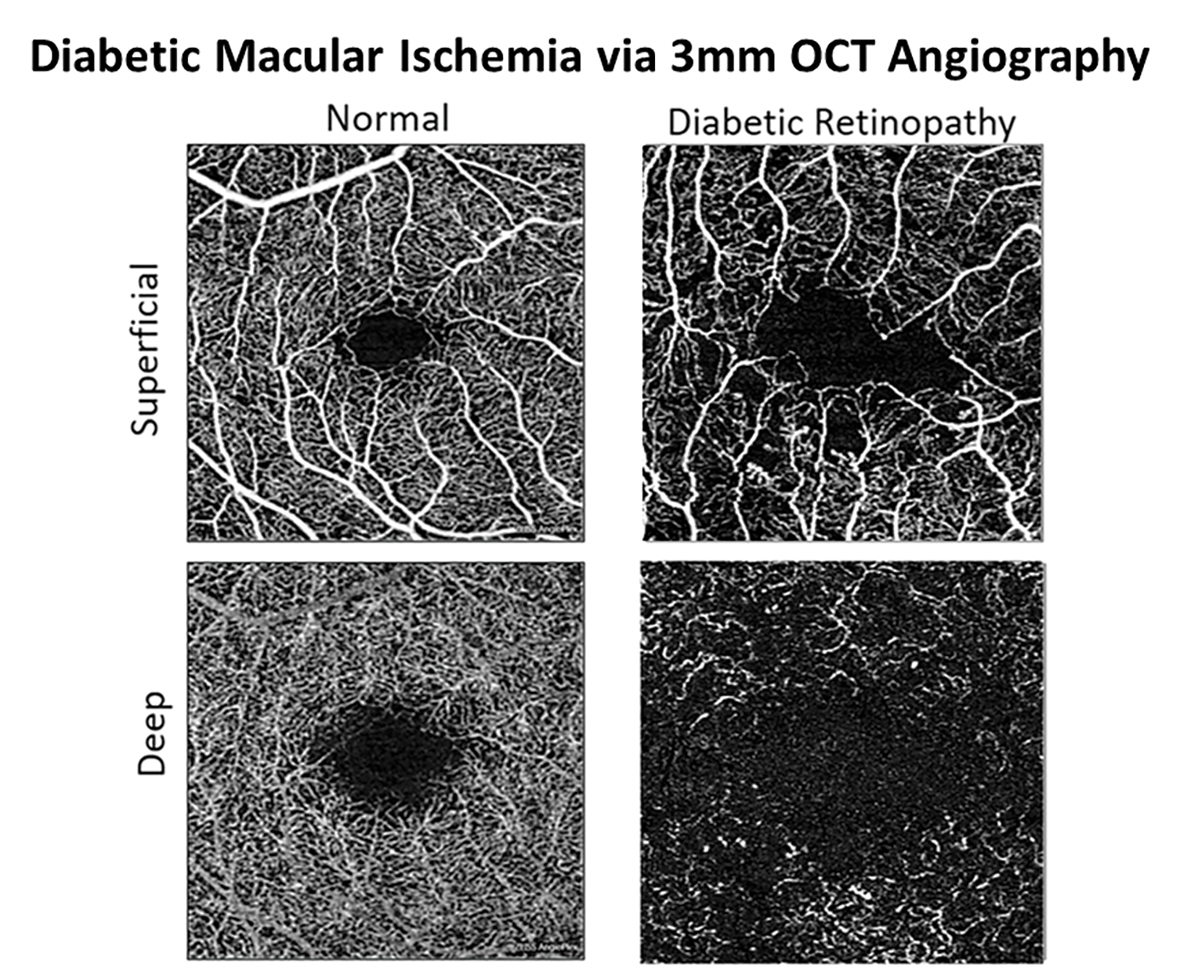 Development of OCT-A has provided a noninvasive method for optometrists to assess capillary nonperfusion, macular ischemia and neovascularization in-office.