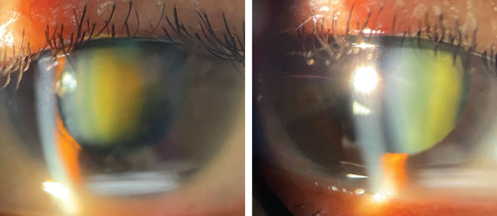 Slit lamp biomicroscopy findings of the patient’s right and left eyes. Why might this presentation appear in a patient with the medical history described here?