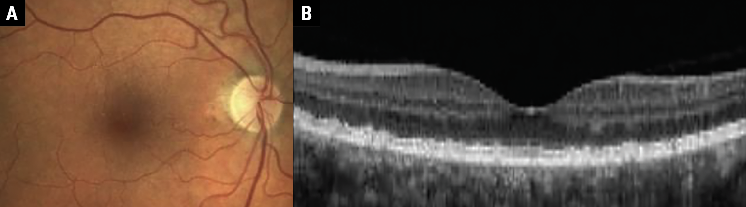 Fig. 1a-b. Early AMD characterized by medium-sized drusen (63μm to 125μm). 